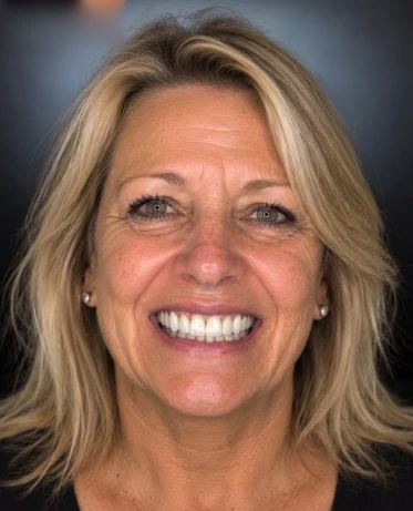 After: the same person’s illustrative bright smile simulation