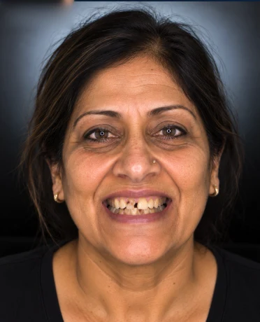Before: the original smile with missing and worn teeth