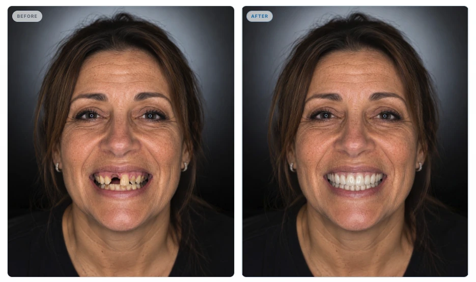 Woman’s original smile beside her SmileInspo-generated smile simulation